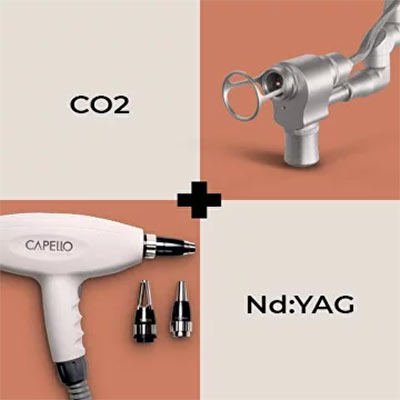 Комбинация CAPELLO с Неодимовым и CO2 лазером